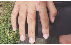 Hand infected with scabies (February 20, 2026). Photo: Courtesy of the Institut national de santé publique du Québec (INSQ)